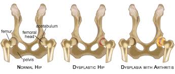 hip dysplasia